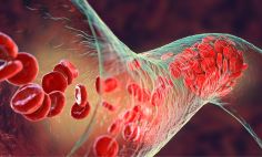 Blood clots can form in your body’s blood vessels. 
