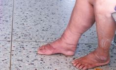Lymphedema causes swelling and stiffness.