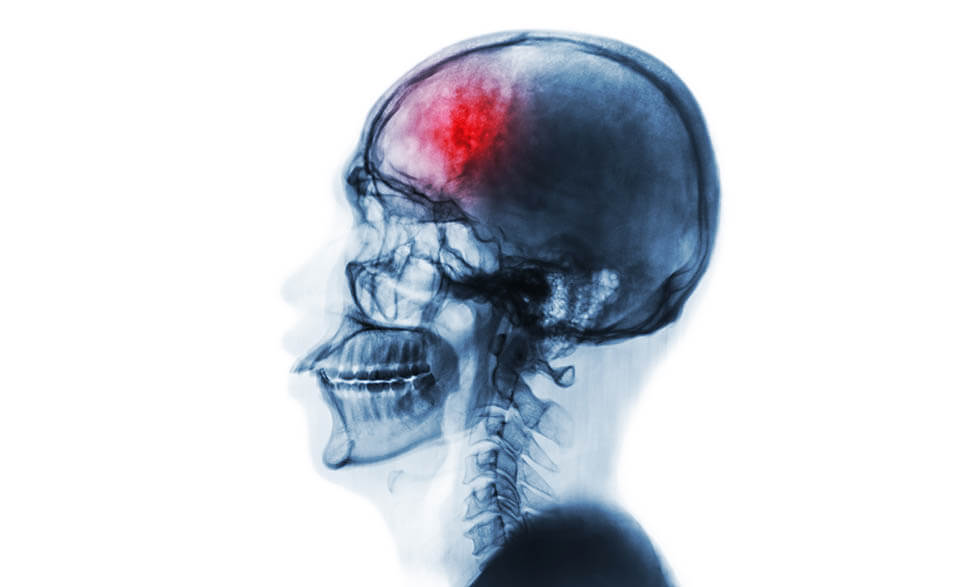 A traumatic brain injury happens after a blow to the head, which can damage brain cells. 