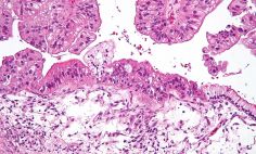 Micrografía de un tumor de ovario mucinoso.