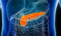 El cáncer de páncreas se forma cuando las células crecen sin control y crean un tumor. Este es difícil de detectar temprano porque puede no presentar señal o síntoma alguno. 