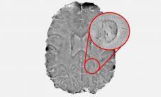 Dark-rimmed spots on the brain, like this one, may suggest a more severe form of multiple sclerosis and help with early detection. 