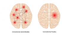 Las convulsiones generalizadas afectan a ambos lados del cerebro, mientras que las convulsiones focales ocurren en un área del cerebro.