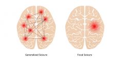 Generalized seizures affect both sides of the brain whereas focal seizures happen in one area of the brain.