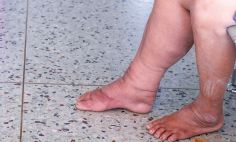 Lymphedema causes swelling and stiffness. 