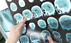 Una resonancia magnética puede ayudar a diagnosticar la esclerosis múltiple.