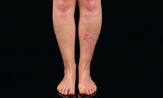 Psoriasis patches (or plaques) often occur on the legs and scalp, as pictured above. But they can occur on the skin anywhere on the body.