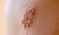 La culebrilla (herpes zóster) forma un sarpullido doloroso provocado por el mismo virus que causa la varicela. 