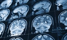 Escaneo de un cerebro humano que muestra los efectos de un accidente cerebrovascular isquémico. 