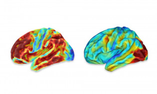 Las imágenes del cerebro de una mujer con una afección hereditaria que causa un Alzheimer de inicio temprano. 