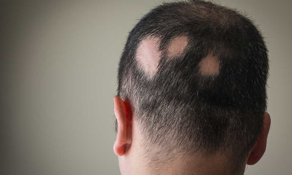 Vegetación Variedad internacional Cinco sugerencias para las personas con alopecia areata | NIH MedlinePlus  Magazine