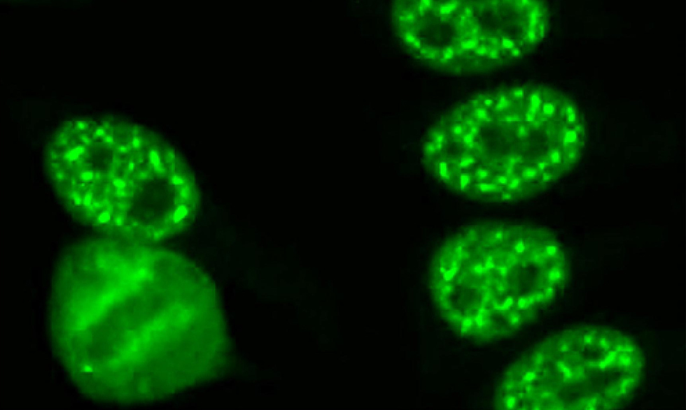 In this image of human cells, the bright dots show ANA, a type of antibody. 