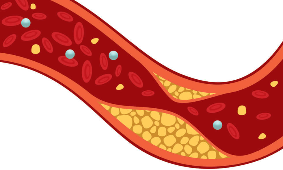 Cholesterol The Good The Bad And The Unhealthy Nih Medlineplus Magazine