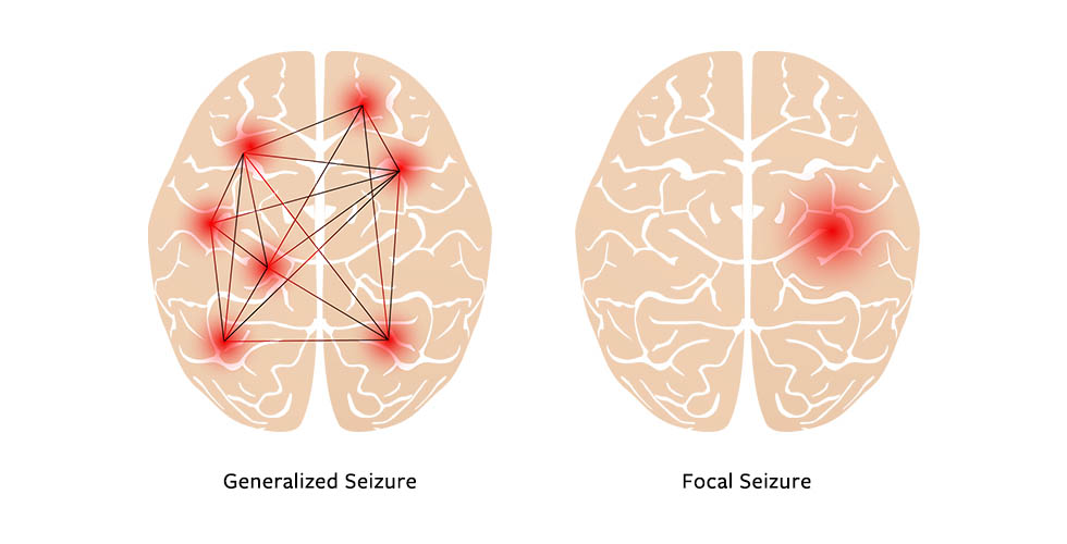 Generalized seizures affect both sides of the brain whereas focal seizures happen in one area of the brain. 