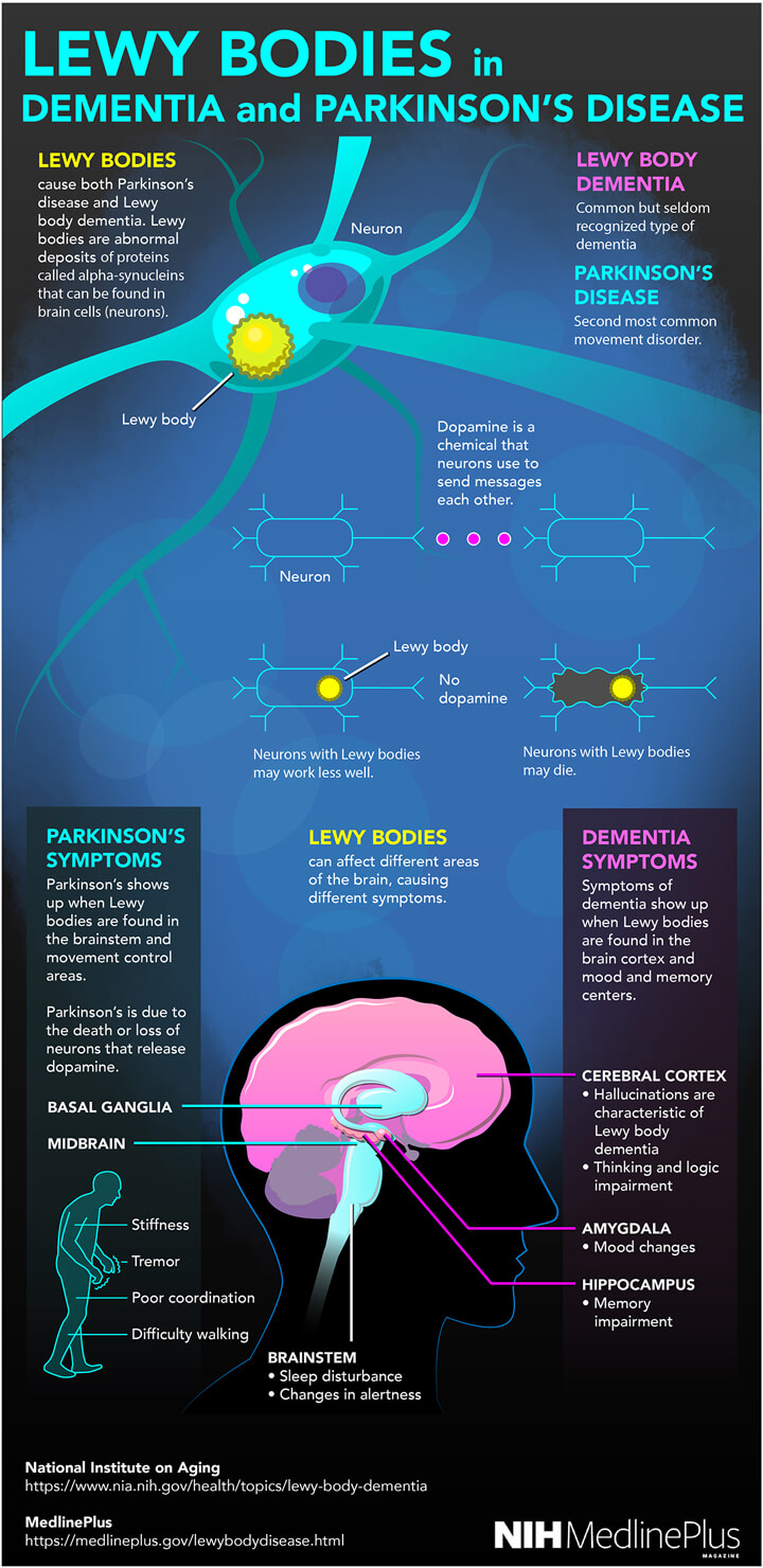 Lewy Body Dementia (LBD): What It Is, Symptoms & Treatment