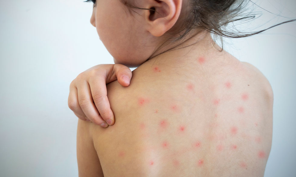 measles-meaning-definition-causes-symptoms-diagnosis-and-treatment