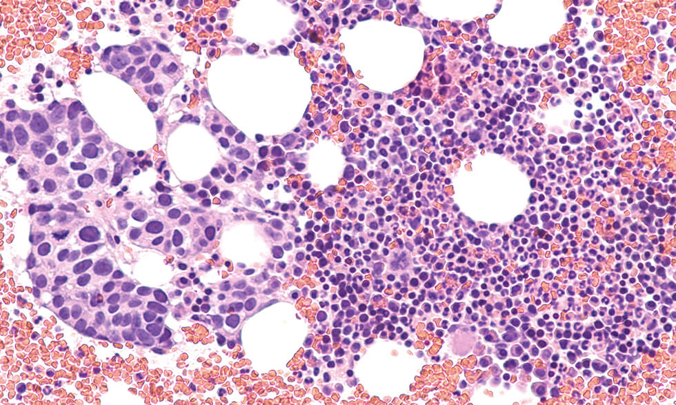 Bone marrow infected with metastatic breast cancer tumor cells. 