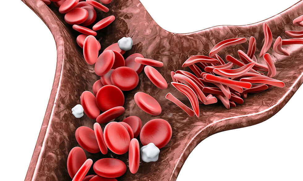 Las células tienen forma de hoz, no son flexibles y pueden adherirse a las paredes de los vasos sanguíneos causando un bloqueo. 