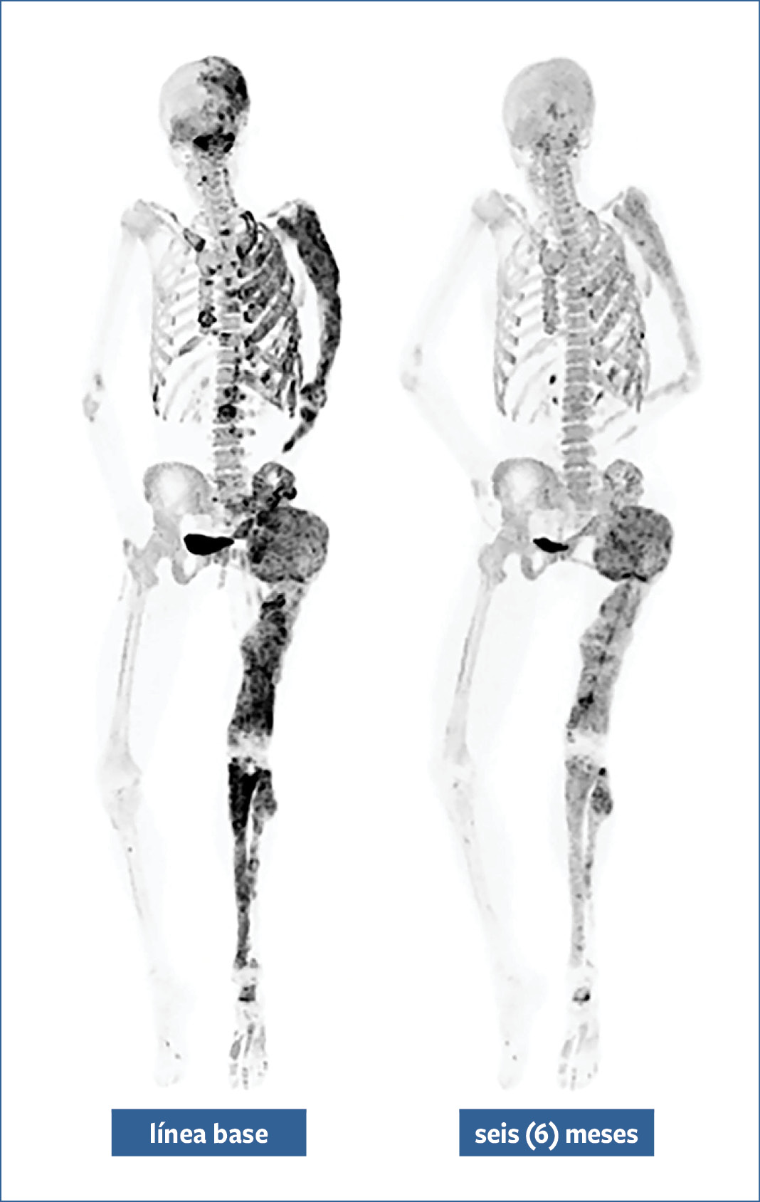 Side-by-side black and white bone scans of a skeleton labeled baseline and 6 months with many and few dark patches.