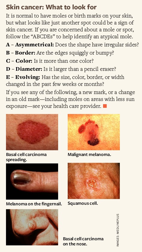 skin cancer types