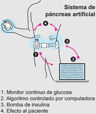 artificial pancreas illustration in Spanish