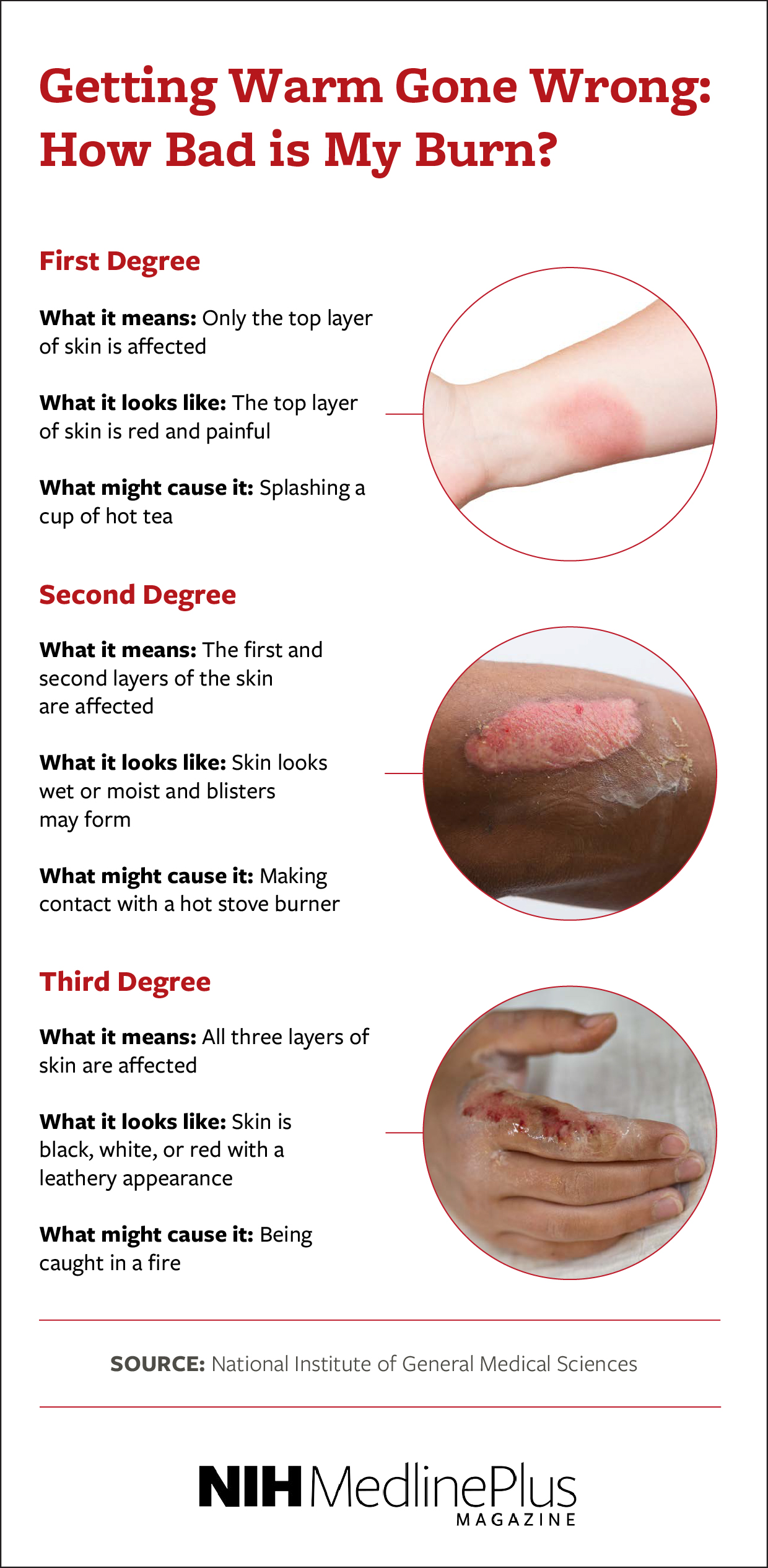 First Degree Put the affected area in cool water or apply a cold, wet compress Apply petroleum jelly a few times each day Consider taking over-the-counter pain medicine like acetaminophen or ibuprofen to ease pain  Protect the affected area from the sun Second Degree Follow all first degree burn treatment recommendations Don’t break any blisters Apply a bandage if the skin or blisters are likely to become irritated by clothing or daily activity, or if the blisters have broken open Third Degree Seek immediate medical attention While waiting for medical help to arrive, cover the affected area in a clean bandage and attempt to raise the affected area above the heart 