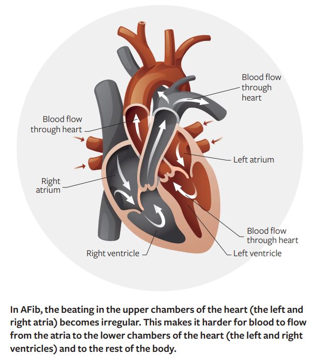 Blood flow through heart, right atrium, right ventricle, left ventricle, blood flow through heart, left atrium, blood flow through heart. In AFib, the beating in the upper chambers of the heart (the left and right atria) becomes irregular. This makes it harder for blood to flow from the atria to the lower chambers of the heart (the left and right ventricles) and to the rest of the body.