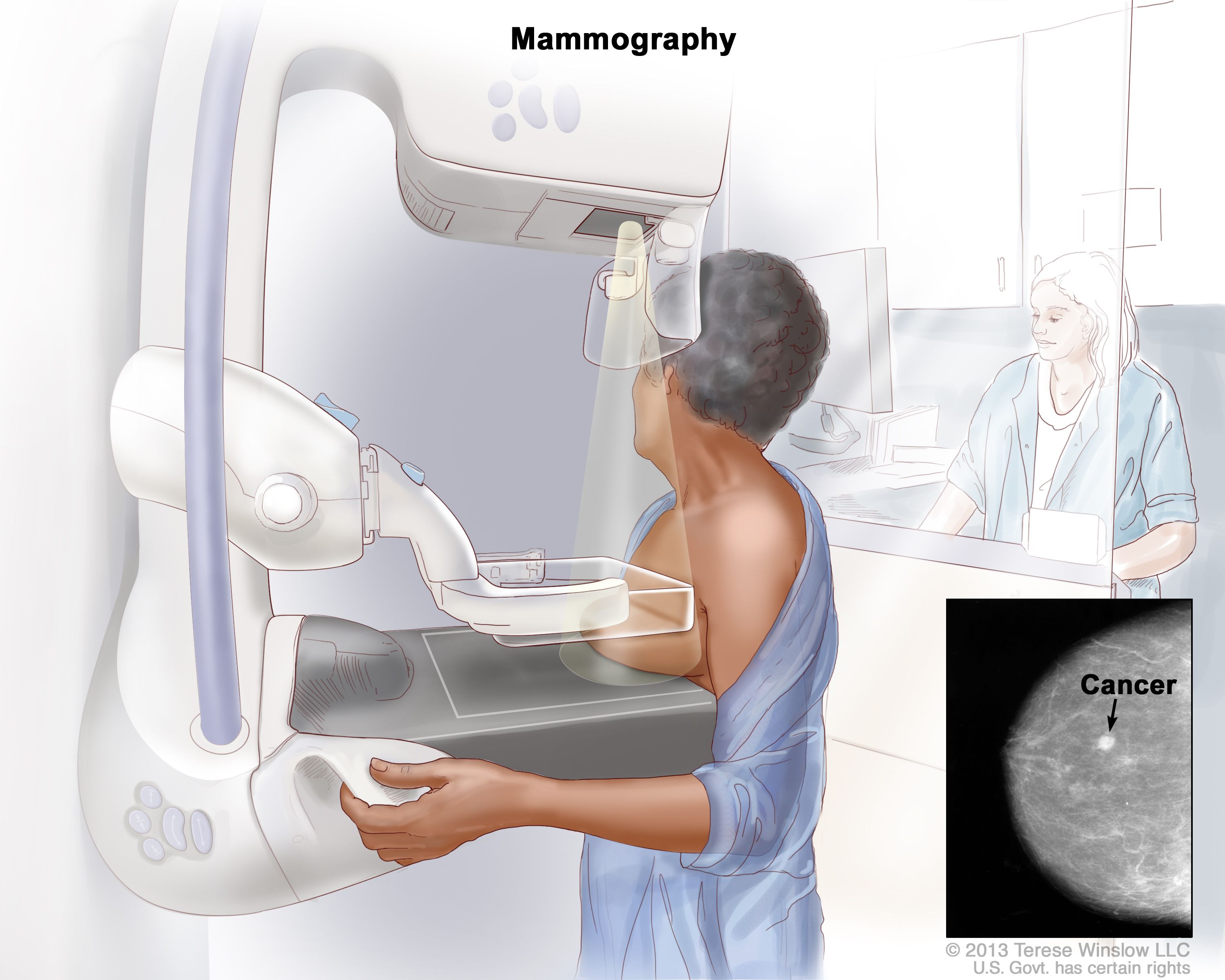 mammogram illustration