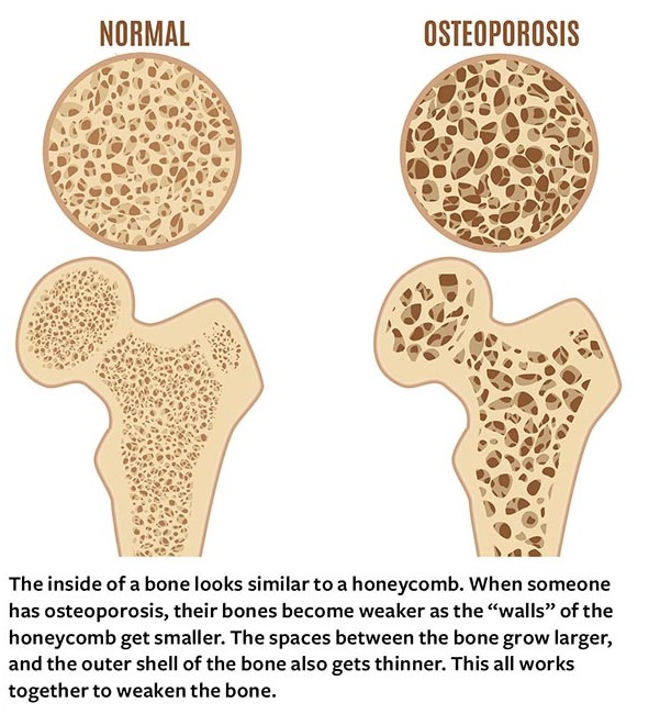 Normal bone. Osteoporosis bone. The inside of a bone looks similar to a honeycomb. When someone 
has osteoporosis, their bones become weaker as the “walls” of the 
honeycomb get smaller. The spaces between the bone grow larger, 
and the outer shell of the bone also gets thinner. This all works 
together to weaken the bone.