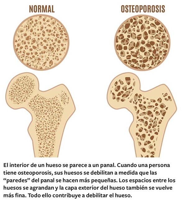 Hueso normal. Hueso con osteoporosis. El interior de un hueso se parece a un panal. Cuando una persona tiene osteoporosis, sus huesos se debilitan a medida que las “paredes” del panal se hacen más pequeñas. Los espacios entre los huesos se agrandan y la capa exterior del hueso también se vuelve más fina. Todo ello contribuye a debilitar el hueso.