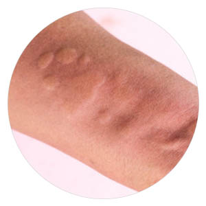 Urticaria